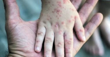 ارتفاع حالات الإصابة بجدرى القرود فى مدغشقر إلى 78 شخصا