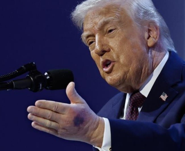 كدمة على يد ترامب