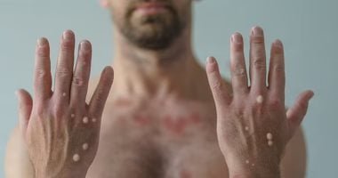 المركز الأفريقى لمكافحة الأمراض يرفع حالة الطوارئ المرتبطة بجدرى القرود