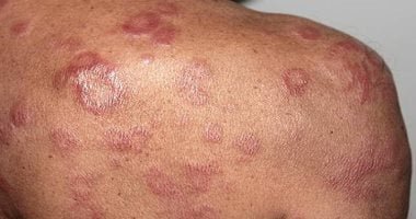 تسجيل أكثر من 140 حالة إصابة بالجذام في منطقة موبا بالكونغو الديمقراطية