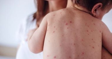 أزمة صحية فى إسرائيل.. وفاة 15 طفلاً بسبب تفشى الحصبة