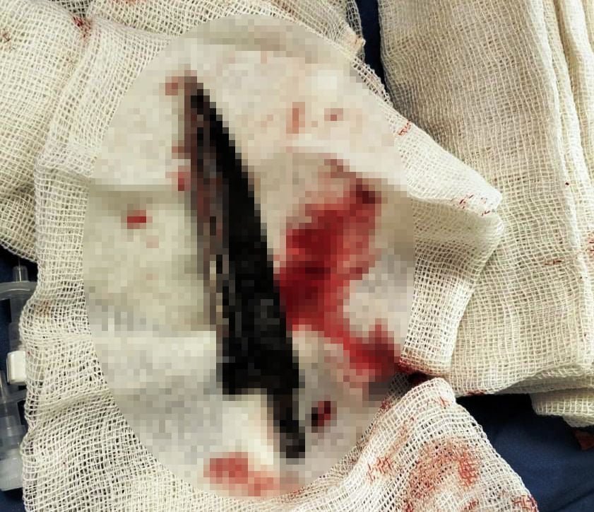 نجاح جراحة عاجلة لإنقاذ مصاب بآلة حادة نافذة بالمخ بمستشفى طوارئ قصر العينى (4)