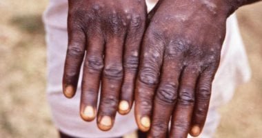 روسيا تعلن تسجيل إصابتين بجدرى القردة بين عائدين من الخارج