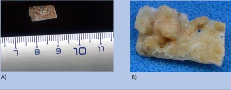 قطع آخرى من الجمجمة 