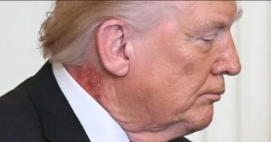 "بقعة حمراء" في رقبة دونالد ترامب تثير التكهنات.. صورة