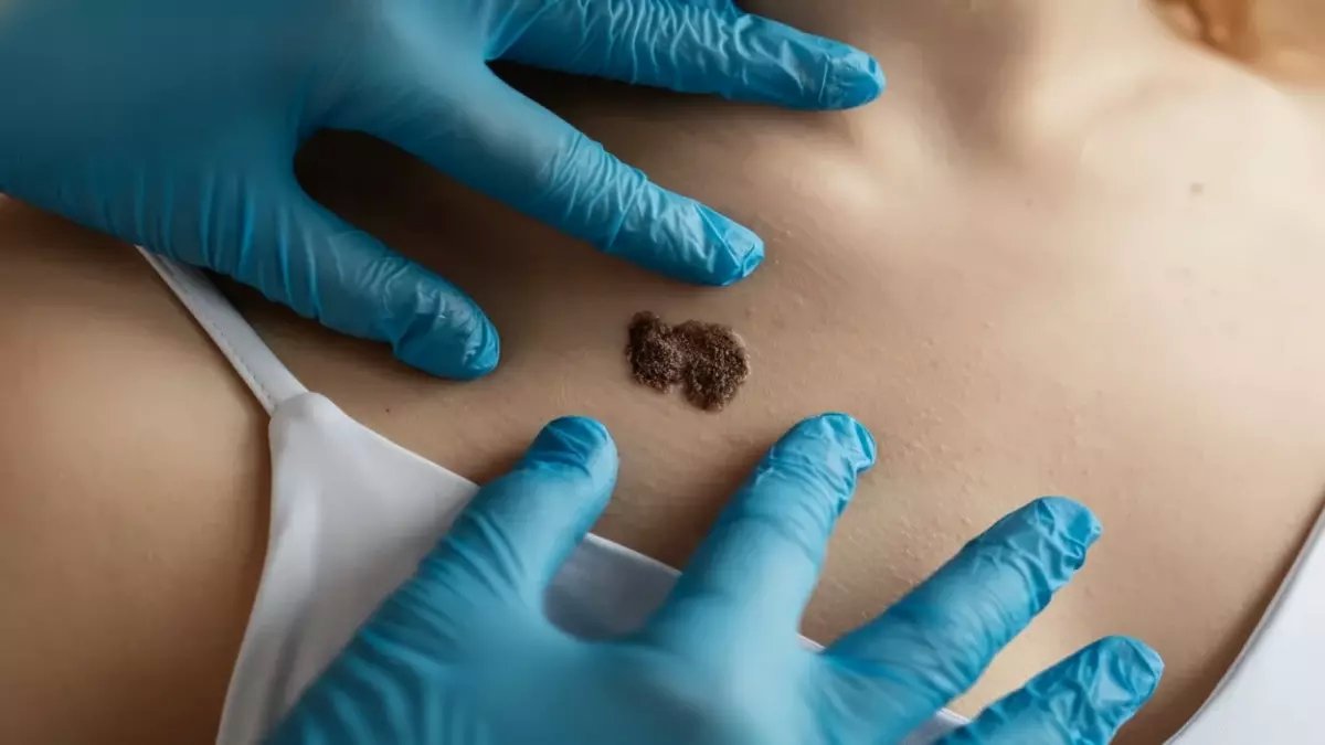 علماء يكشفون: انخفاض مذهل بنسبة 47% في سرطان الجلد عند الأطفال... السر وراء هذا التحول الطبي المفاجئ!