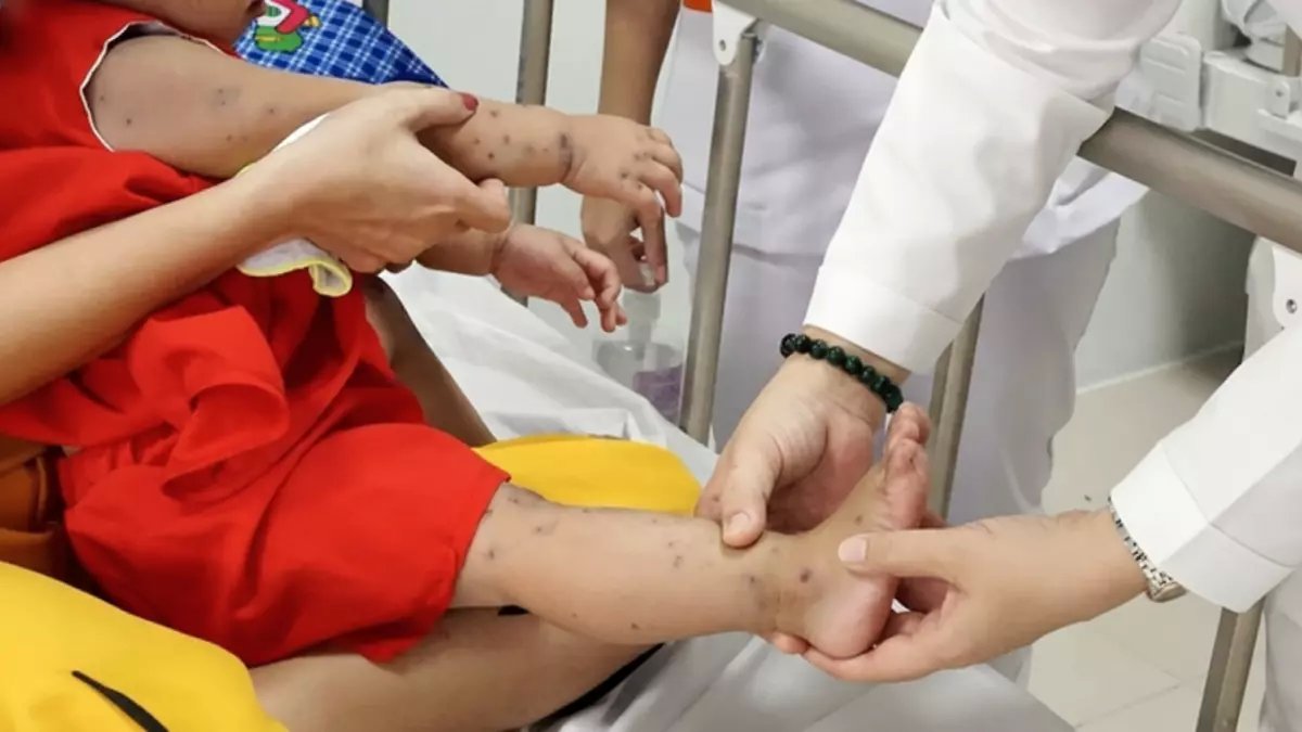 عاجل: فيروس خطير يهاجم الأطفال في فيتنام... ارتفاع الحالات الشديدة 400% والمستشفيات تعلن حالة الطوارئ!